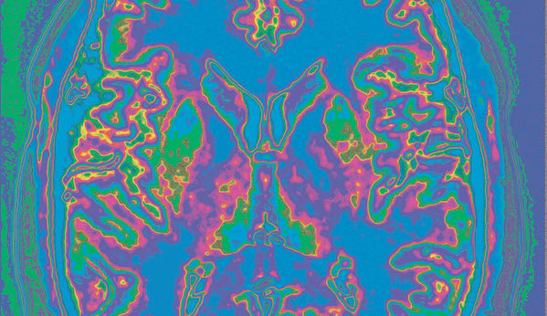 color-enhanced MRI scan of the brain
