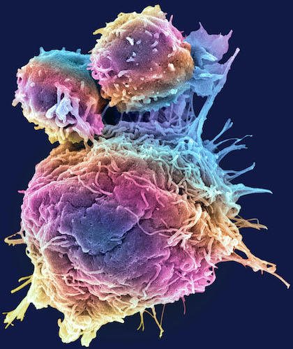 A scanning electron micrograph of T lymphocyte cells (smaller round cells) attacking a cancer cell