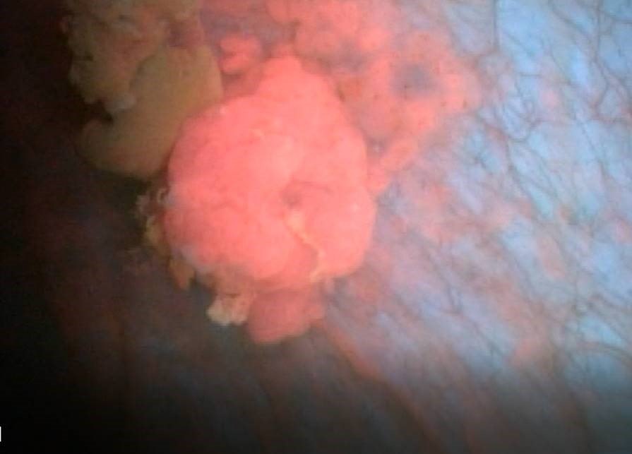 Cancer appears pink when examined under blue light.