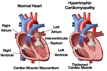 Home - Hypertrophic Cardiomyopathy Association