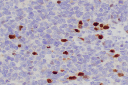 Embryonal rhabdomyosarcoma cells