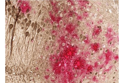 Toxic amyloid plaques red and tau tangles brown form on the brain of a mouse