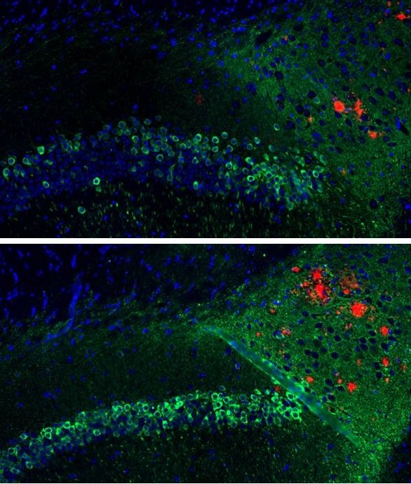 Above: A DNA vaccine given to a mouse modeled to have Alzheimer’s disease reduced beta-amyloid plaques (red) and tau tangles (green) in the hippocampus region of the brain. Below: An untreated mouse modeled to have Alzheimer’s disease accumulated notably more beta-amyloid plaques (red) and tau tangles (green) in the hippocampus region of the brain.