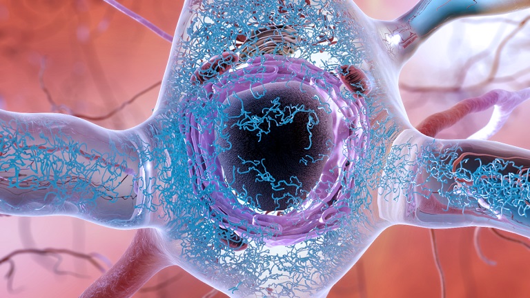 Abnormal accumulations of a protein called tau can collect inside neurons, forming tangled threads and eventually harming the synaptic connection between neurons. Credit: National Institute on Aging.