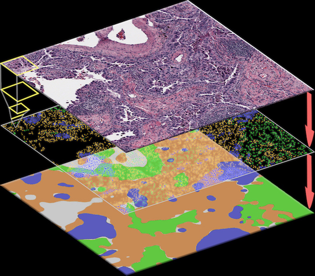 This illustration of the ConvPath software workflow shows how the AI algorithm automatically recognizes each cell in the pathology image (upper image) as a tumor cell (orange), stromal cell (green), or lymphocyte (blue), then converts the image into a spatial map (middle image). Clusters of tumor cells are further identified as tumor regions (orange areas in the bottom image).
