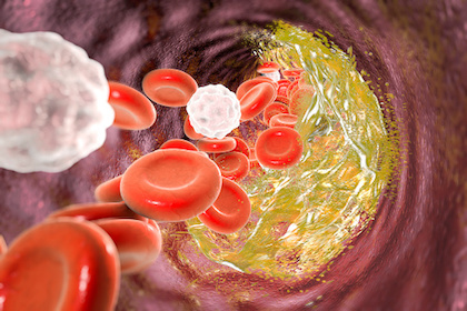 Illustration of cholesterol causing a narrowing of an artery