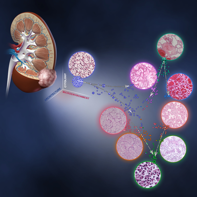 Illustration of the nine distinct patterns of ccRCC morphology based on extensive analysis of tumor architecture, cytology, and microenvironment