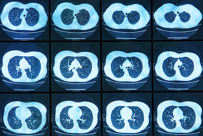 Magnetic resonance image of the chest