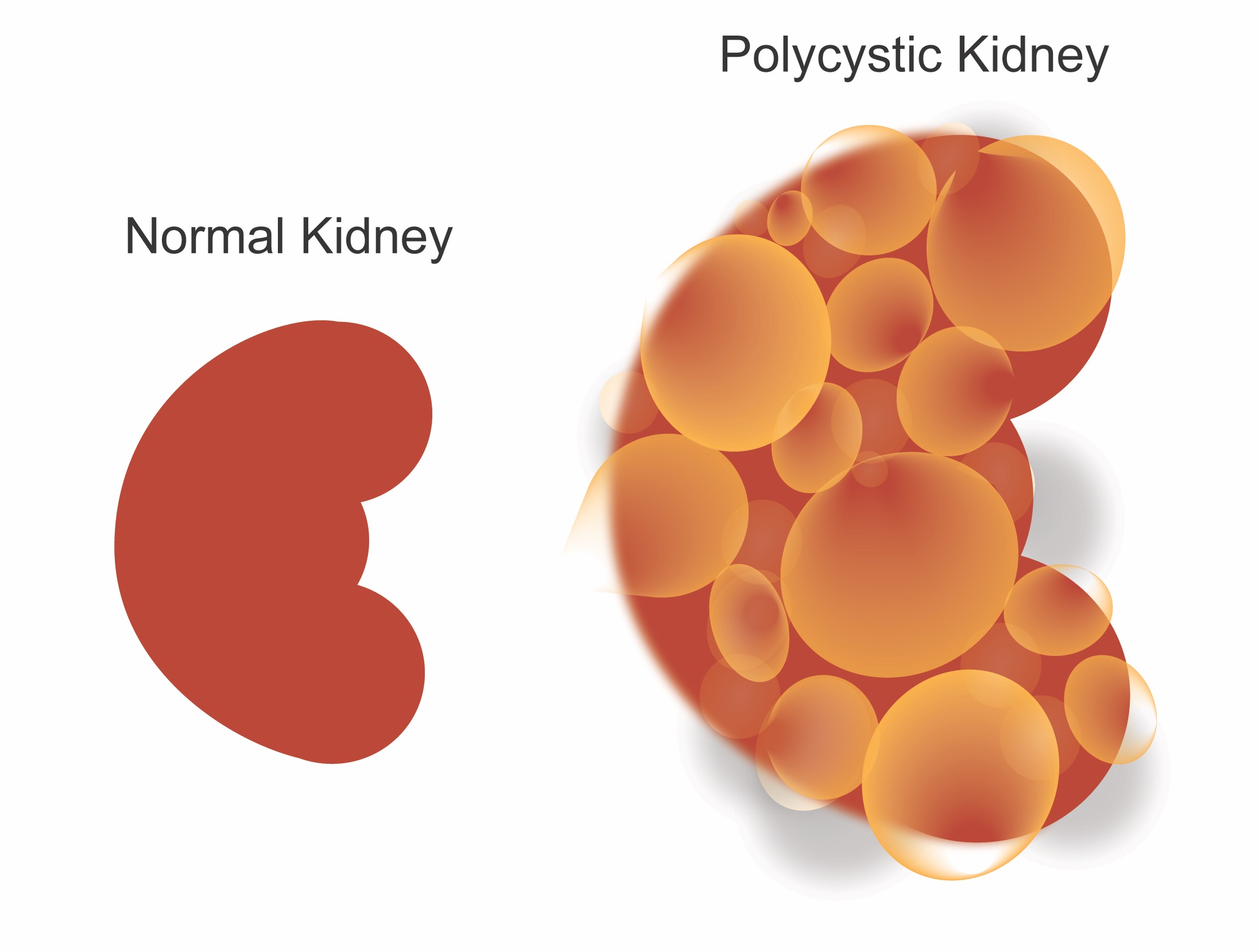 Illustration comparing a normal kidney and a PKD kidney