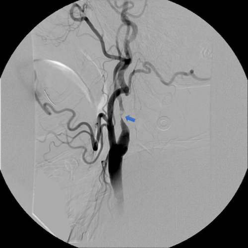 The blue arrow points to severe blockage of an artery in the neck carrying blood to a large brain area.