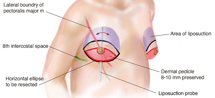 New technique retains nipple color in men after breast reduction