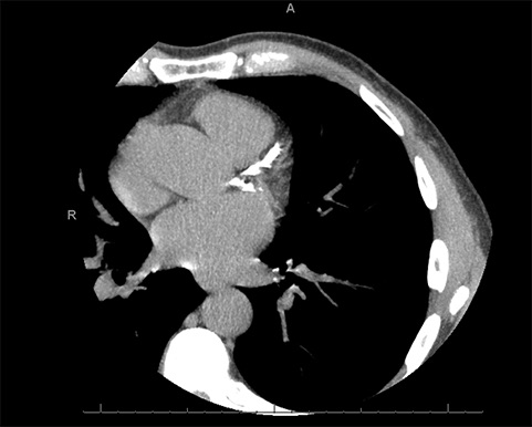 Coronary artery calcium scans