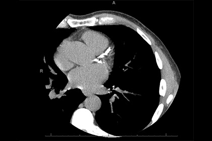 Coronary artery calcium scan