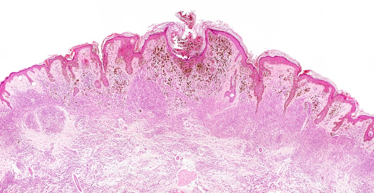 Melanoma cells