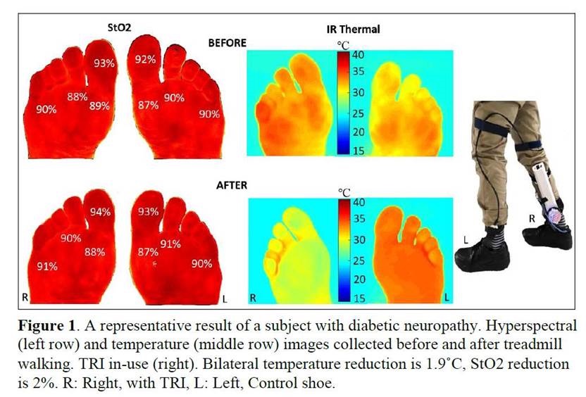 Representative infrared results of an individual with diabetic neuropathy