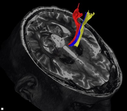 Red, white, and yellow lines show movement of water molecules in a diffusion tractography