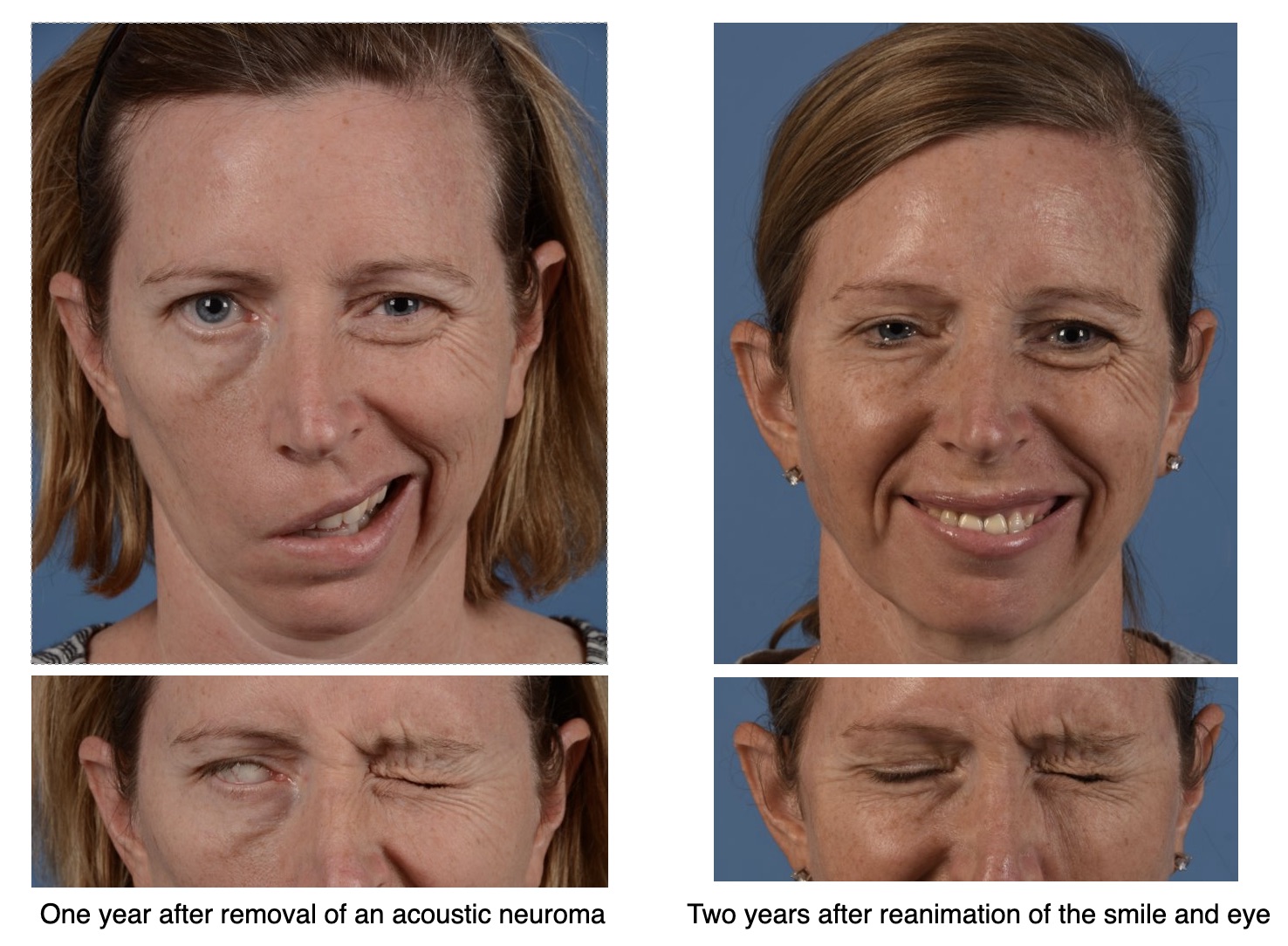 Above are before and after surgery photos of a 44-year-old patient following removal of an acoustic neuroma. She did not have the ability to smile or close her eyes voluntarily. Two years after surgical reanimation for the midface and the eye, she attained symmetry in her smile and the ability to close her eye voluntarily.