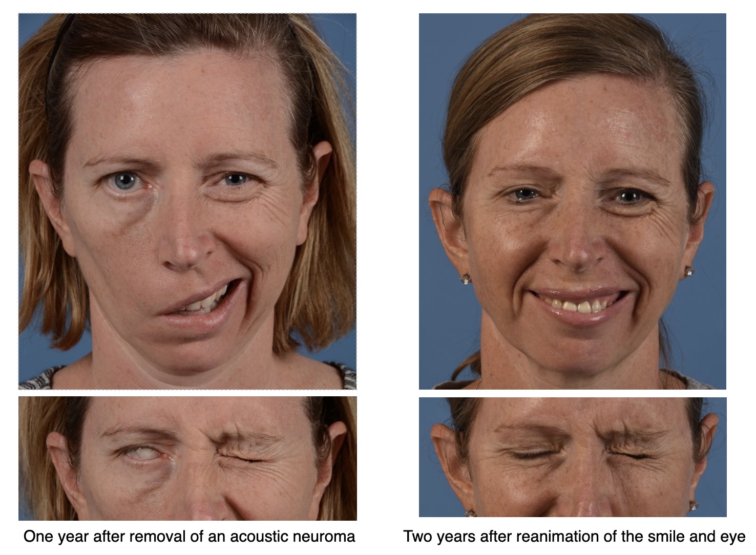 Facial Nerve Paralysis Scale