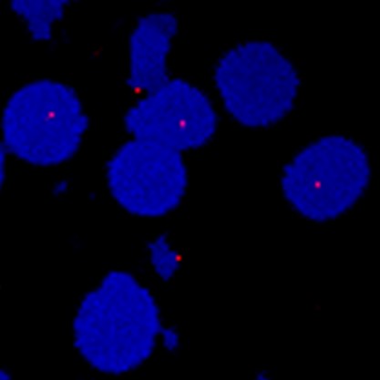 HIF-2 complex in kidney cancer cells