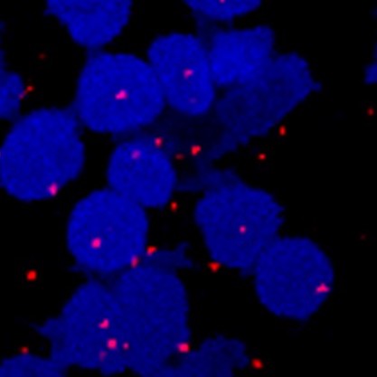 HIF-2 complex in kidney cancer cells