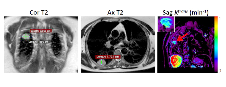 Scans of a tumor in the lung