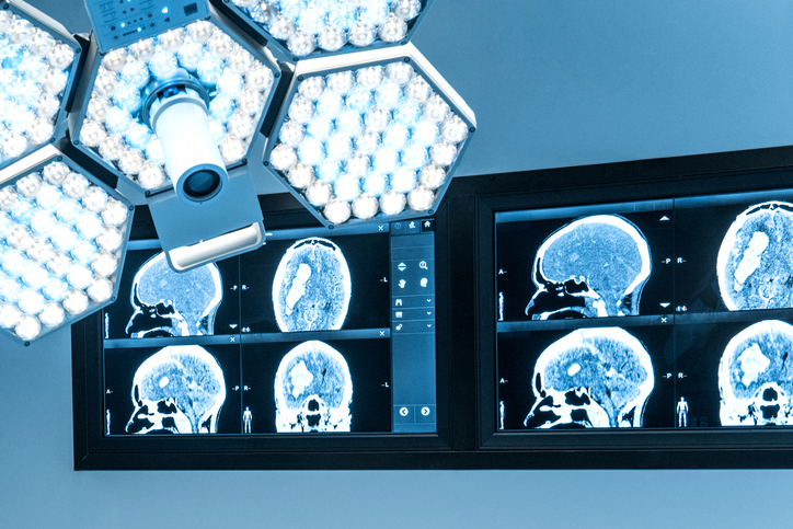 MRI images of a brain on a screen in an operating room
