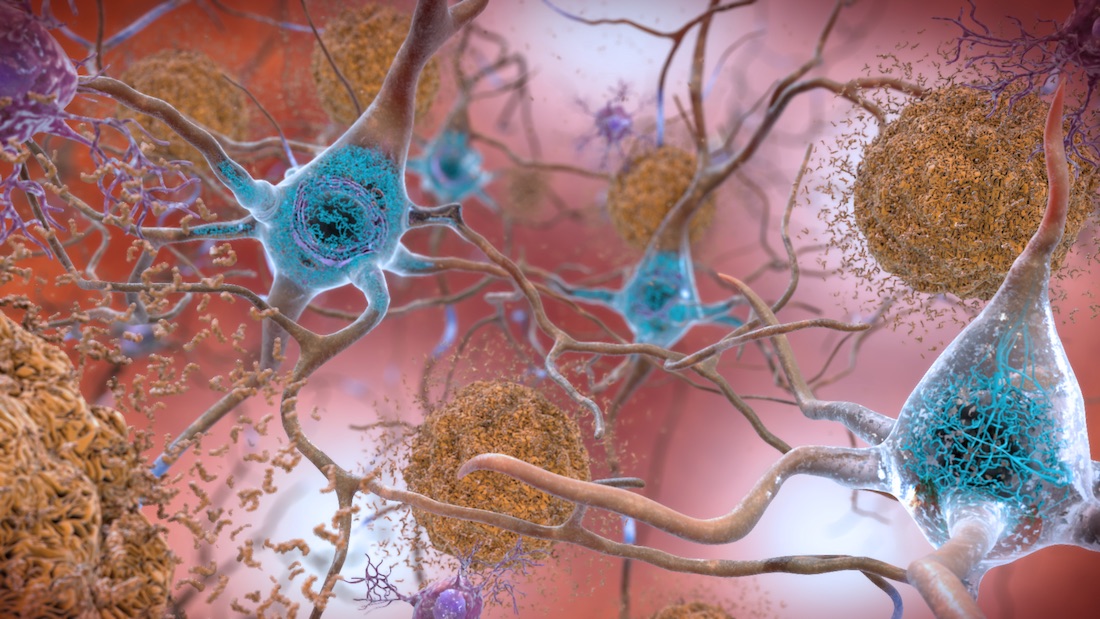 Photo of Amyloid beta plaques and tau in the brain