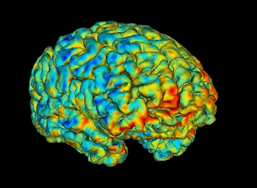 Photo of UTSW-led research identifies new imaging biomarkers that predict antidepressant response