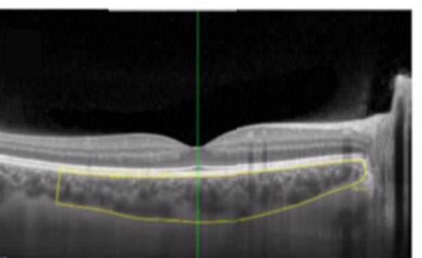 Photo of The choroid, a thin layer in the middle of the eyeball’s wall