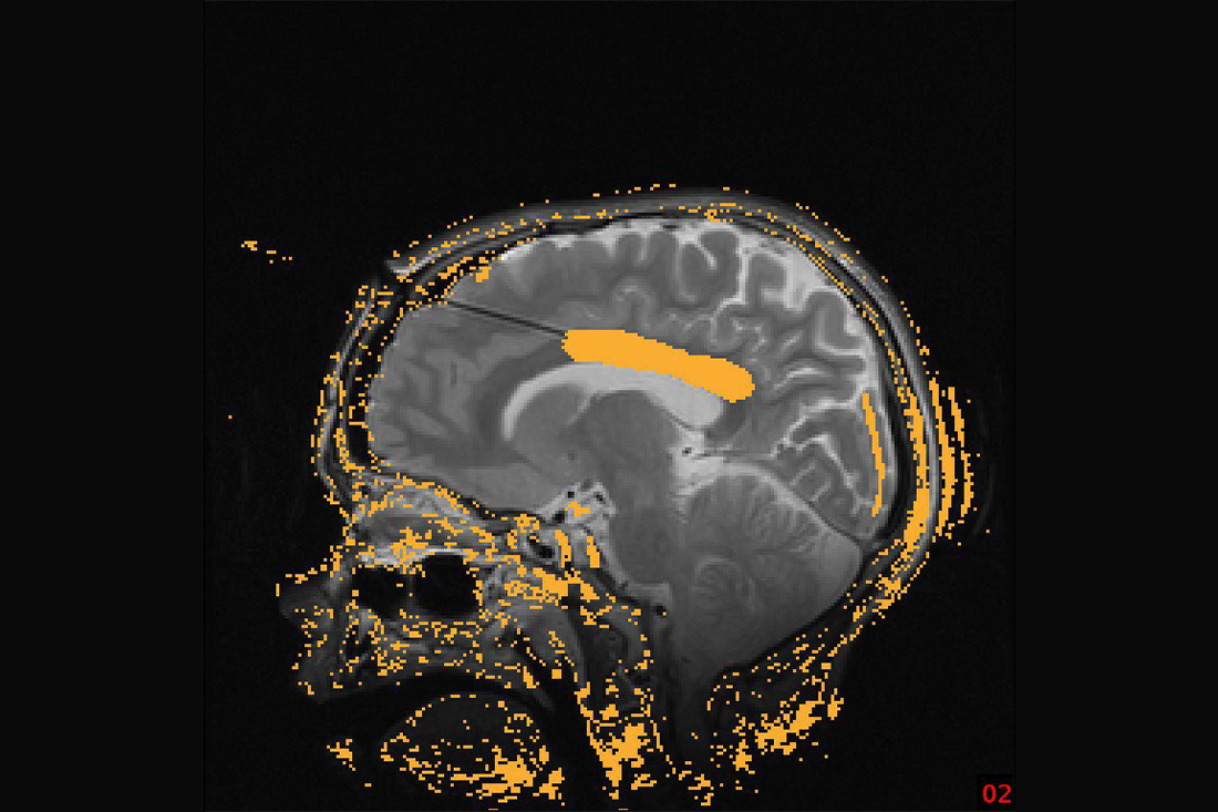 Corpus Callosum