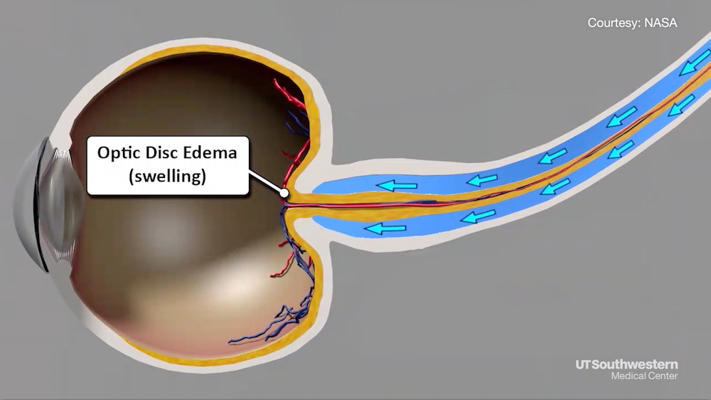 Photo of Eye swelling