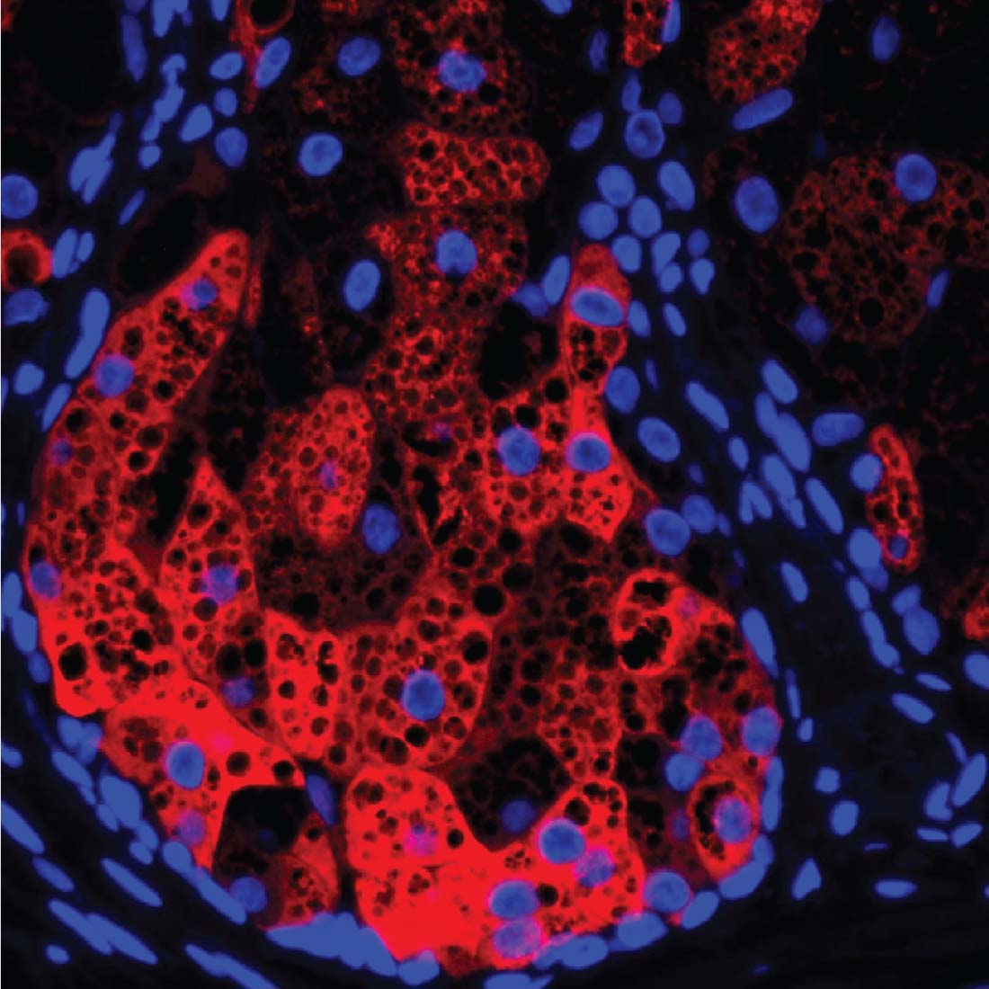 This illustration shows HSD3B1 (red) within a human sebaceous gland, cell nuclei (blue), and lipid droplets (black circular areas). 