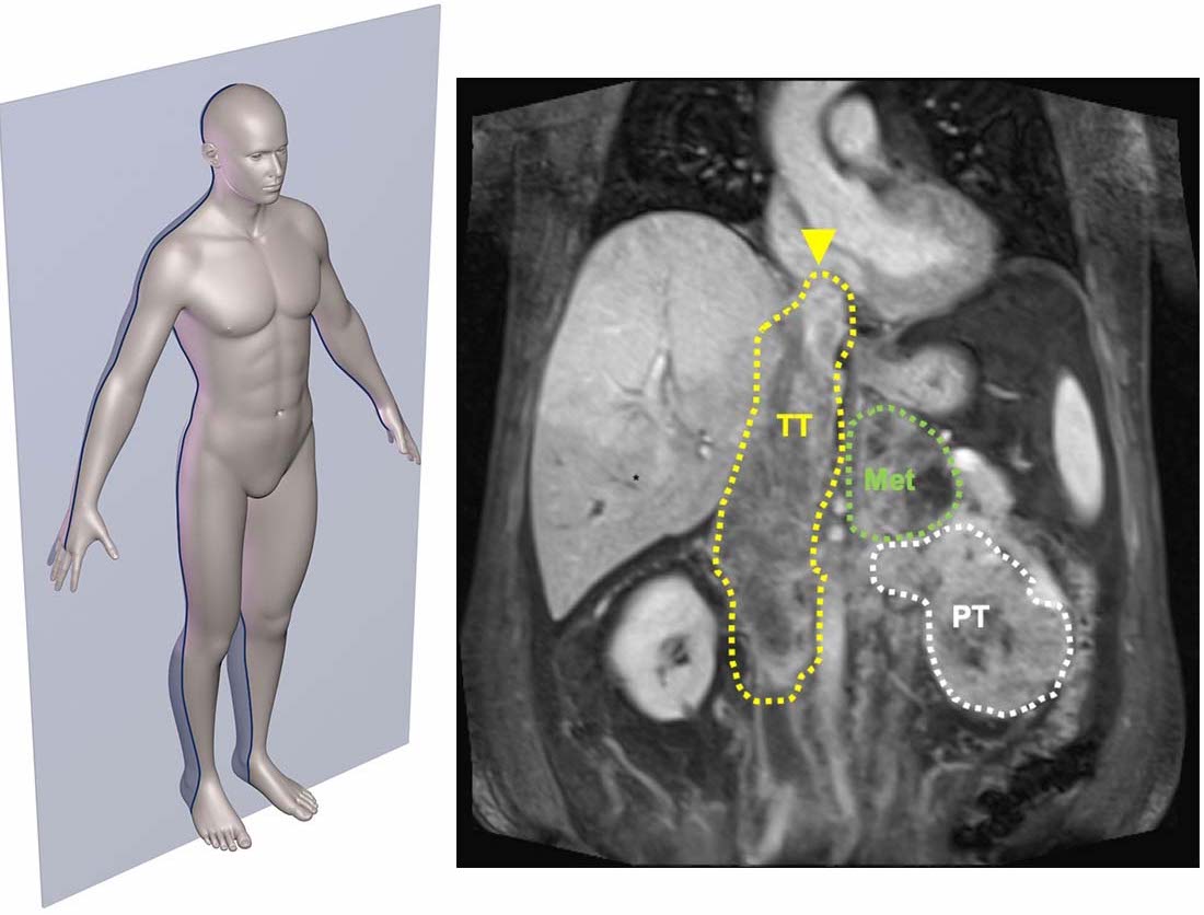 Photo of MRI of patient with a kidney primary tumor (PT) 