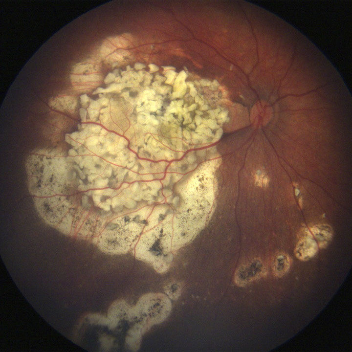 Inactive remnant of retinoblastoma tumor following successful intra-arterial chemotherapy