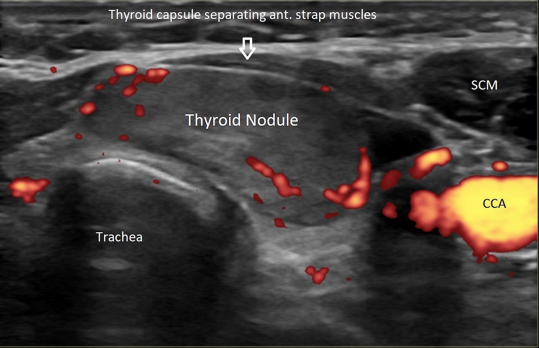 Thyroid Nodule Ultrasound