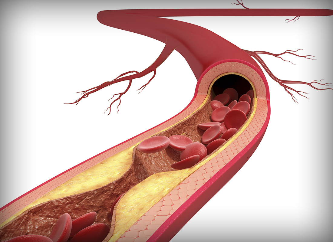 An illustration shows narrowing of an artery resulting from atherosclerosis