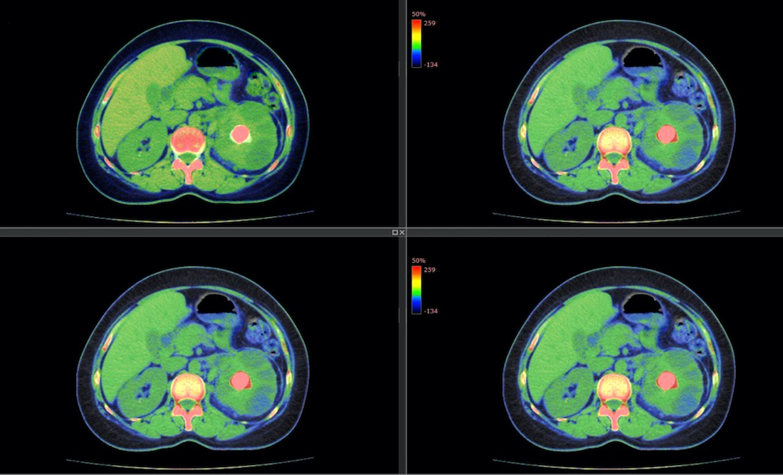 Scans showing a renal stone (pink), or nephrolithiasis, in the right kidney