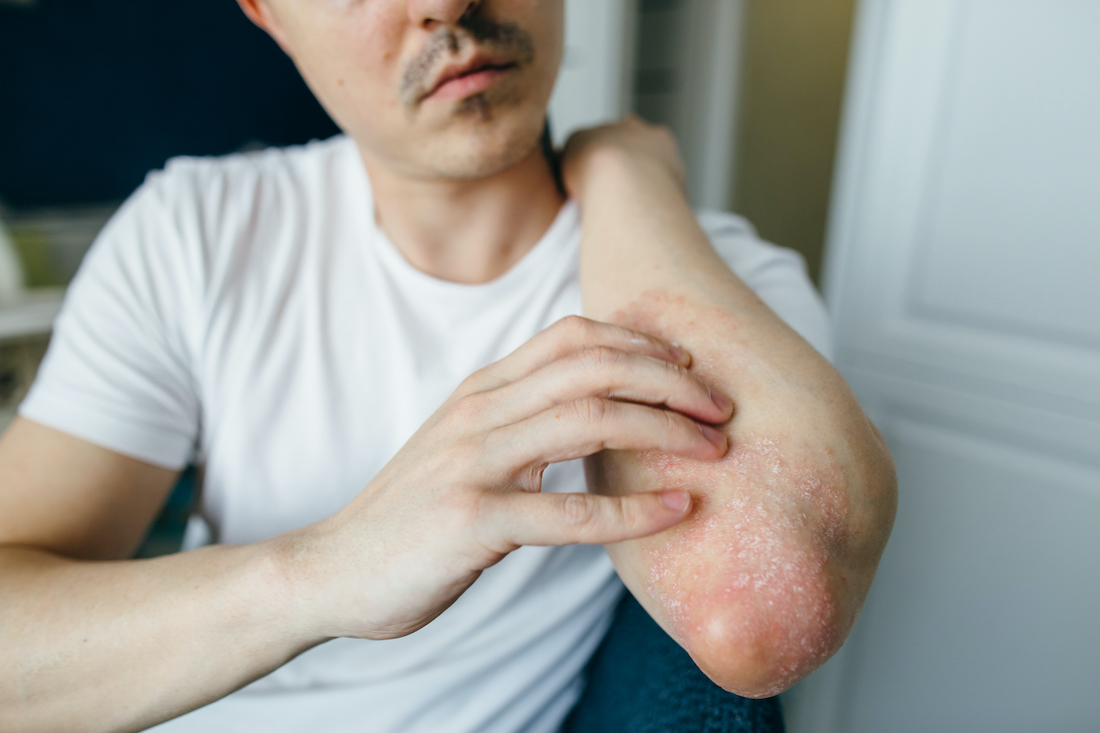 Man scratches the flaky skin on his hands with eczema, psoriasis and other skin diseases such as fungus, plaque, rash and spots