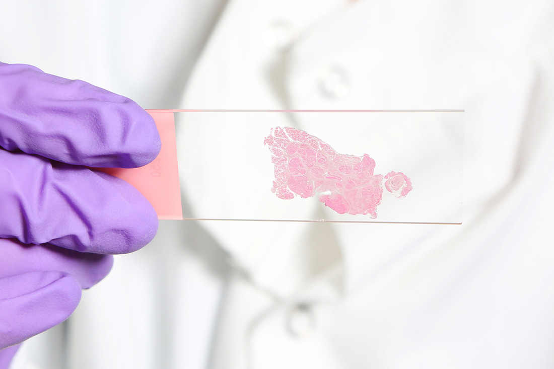 Female scientist with a slide with a breast tumour