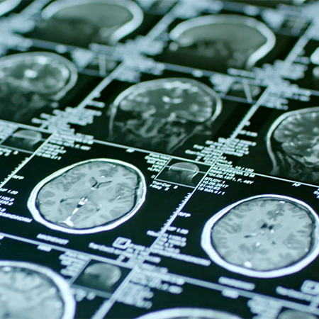 Advancing Neuromodulation Therapies