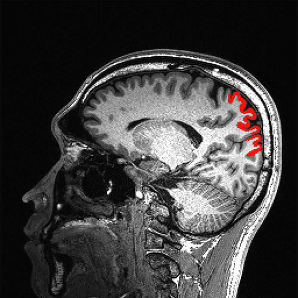 MRI scan