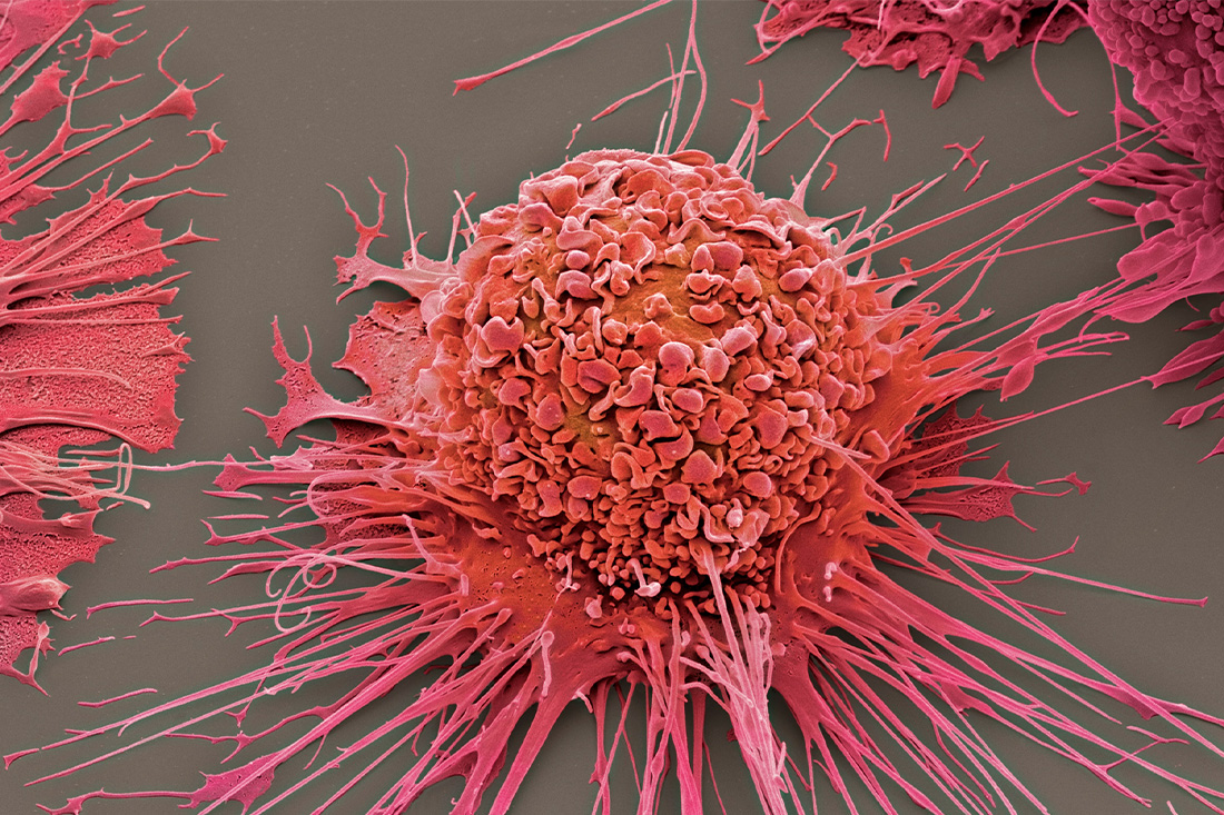 Activated human macrophage, coloured scanning electron micrograph (SEM).