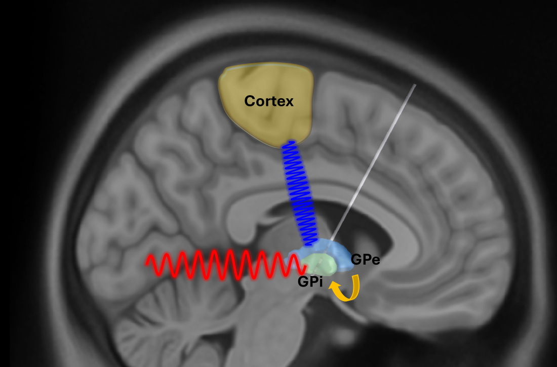 Abnormal brain rhythms may spread through the movement-control network in Parkinson&rsquo;s disease