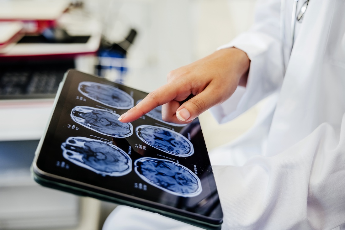 A close-up view of a doctor's hand pointing at brain scan images displayed on a digital tablet. 