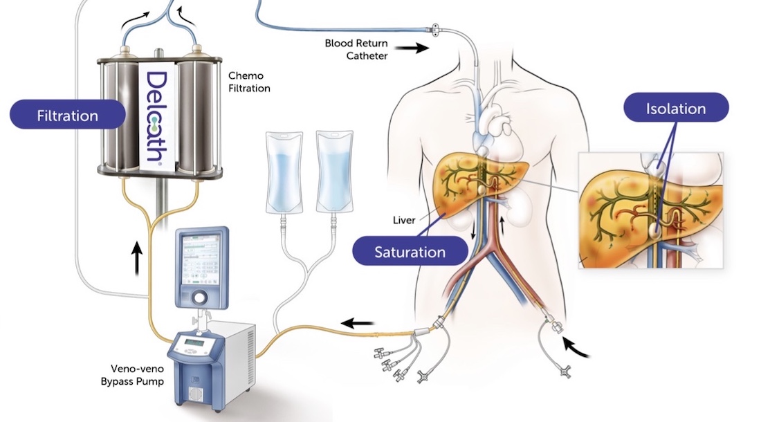 Hepzato Kit treats cance