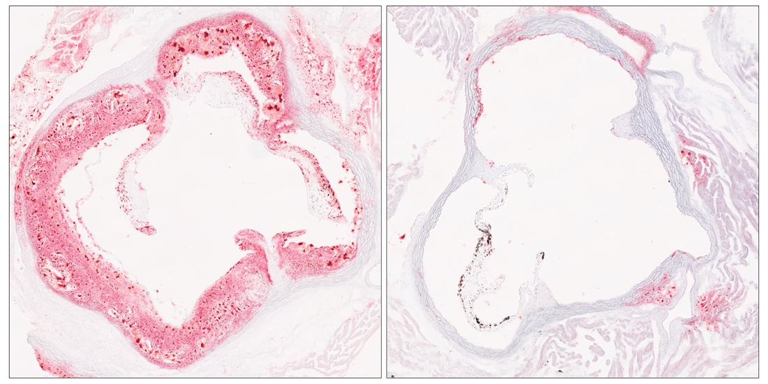 apolipoprotein B a gene involved in the formation of lipoproteins