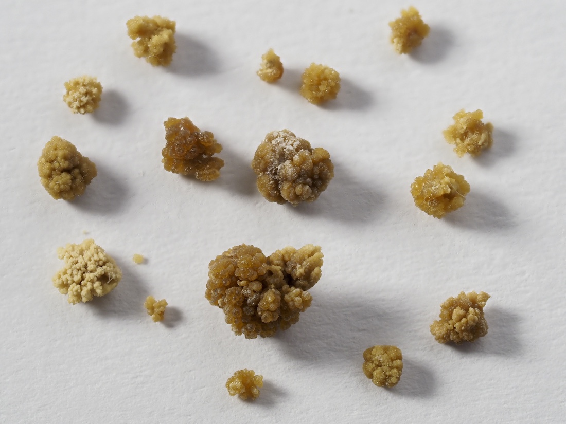 A set of kidney stones of different sizes.