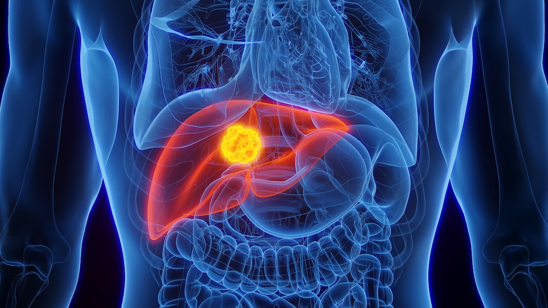 Liver cancer, illustration