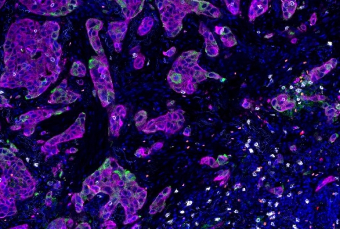 Lung tumors with the KRAS G12D mutation 